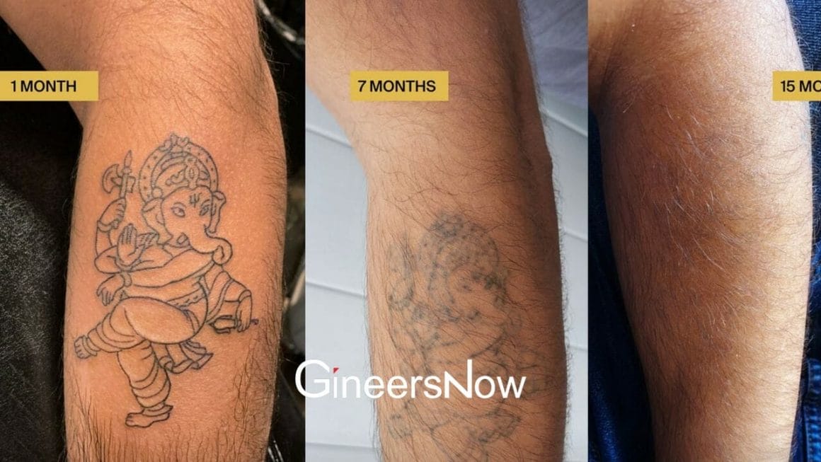 Ephemeral Tattoo Technology: Disappearing Tattoos After 1 Year