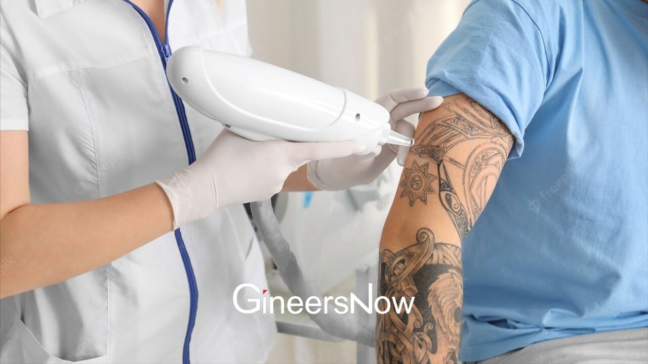 4. Laser Tattoo Removal technology, gadgets, medical - GineersNow